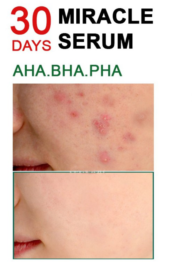 Corea Del Sur SOMEBYMI Saber Honey Tea Tree Three Acid Essence 50Ml Adecuado Para El Control Del Aceite De La Piel Sensible Al Acné